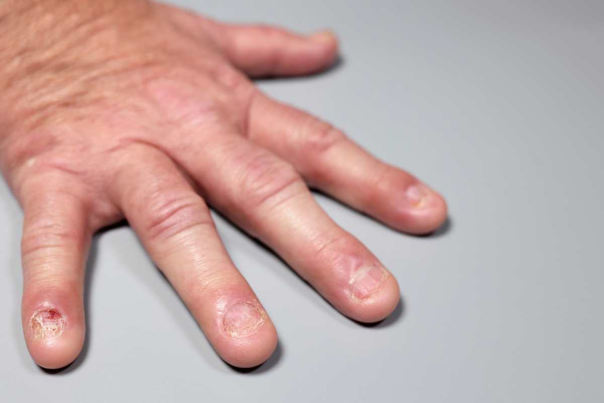 Taches blanches sur les ongles carence